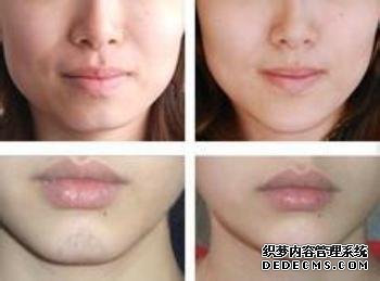 共振吸脂去掉双下巴效果怎么样?要注意什么?