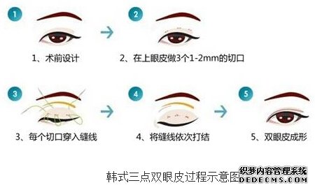 韩式三点定位双眼皮的手术过程是怎样的?