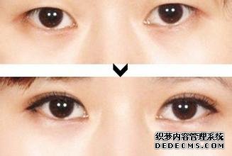 苏薇洁是怎样的医生,做双眼皮怎样?