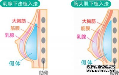 假体隆胸多少钱?副作用?