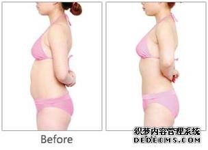 激光溶脂的效果如何? 注意事项