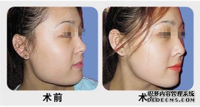 上海华美李志海磨骨怎么样?价格?